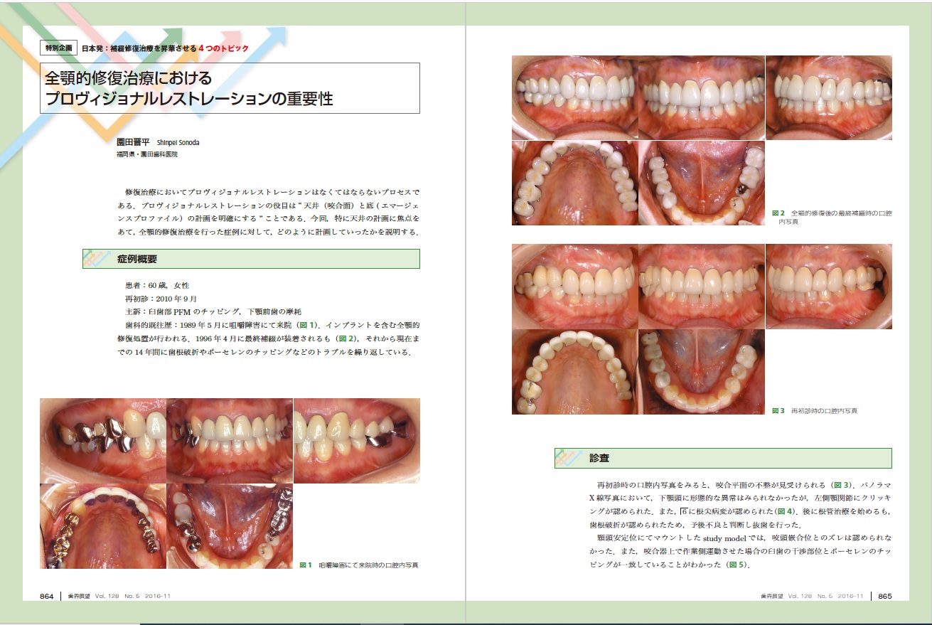 全額的修復治療におけるプロヴィジョナルレストレーションの重要性