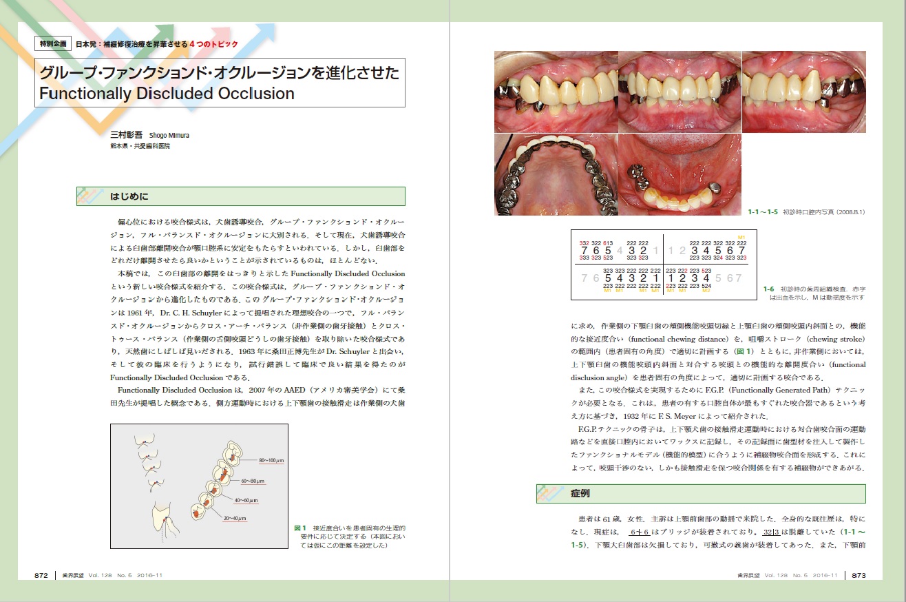 グループ・ファンクションド・オクルージョンを進化させたFunctionally Discluded Occlusion